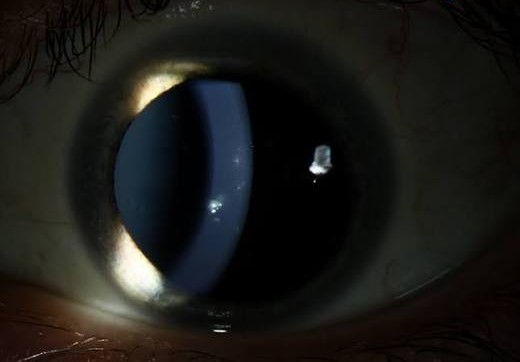 Thygeson Superficial Punctate Keratitis: coarse grey-white intraepithelial corneal opacities (Thygeson dots) seen on slit-lamp retroillumination during an active flare