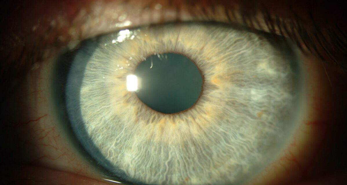 Thygeson Superficial Punctate Keratitis: A Chronic Recurrent Enigma