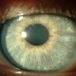 Thygeson Superficial Punctate Keratitis: quiet left cornea with only faint residual epithelial opacities after topical ciclosporin A treatment