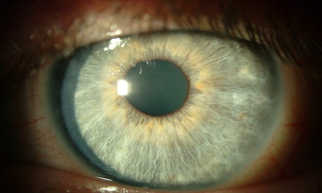 Thygeson Superficial Punctate Keratitis: A Chronic Recurrent Enigma