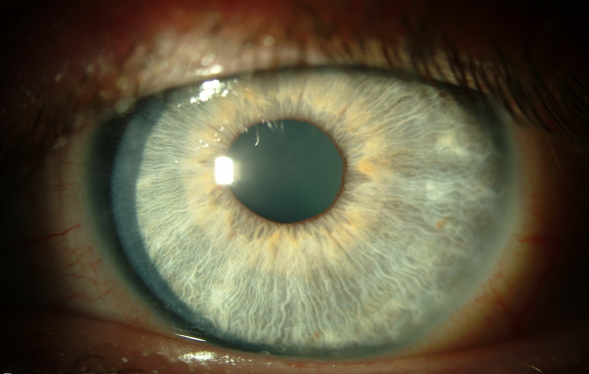 Thygeson Superficial Punctate Keratitis: quiet left cornea with only faint residual epithelial opacities after topical ciclosporin A treatment