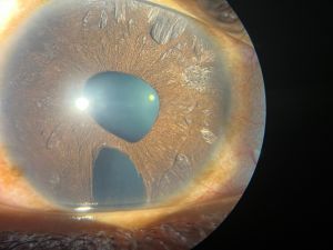 Iridocorneal Endothelial (ICE) Syndrome