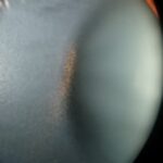 Pigmentary Glaucoma