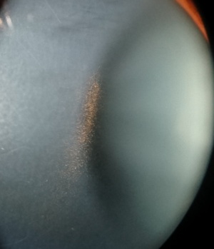 Pigment Dispersion Syndrome& Pigmentary Glaucoma: From Krukenberg Spindle to IOP