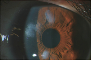 Salzmann Nodular Degeneration: Clinical Features and Management