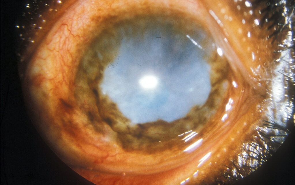 Onchocerciasis: River Blindness and Its Ocular Findings