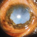 Onchocerciasis