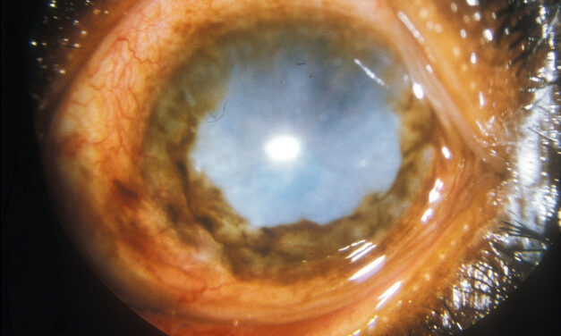 Onchocerciasis: River Blindness and Its Ocular Findings