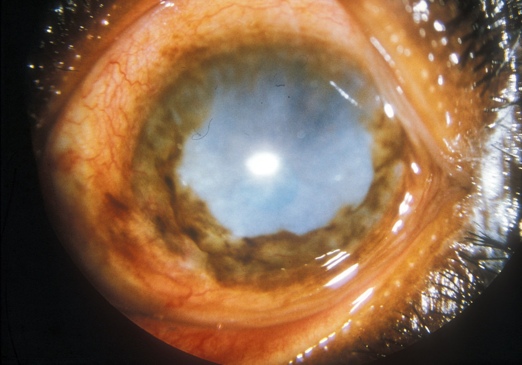Onchocerciasis