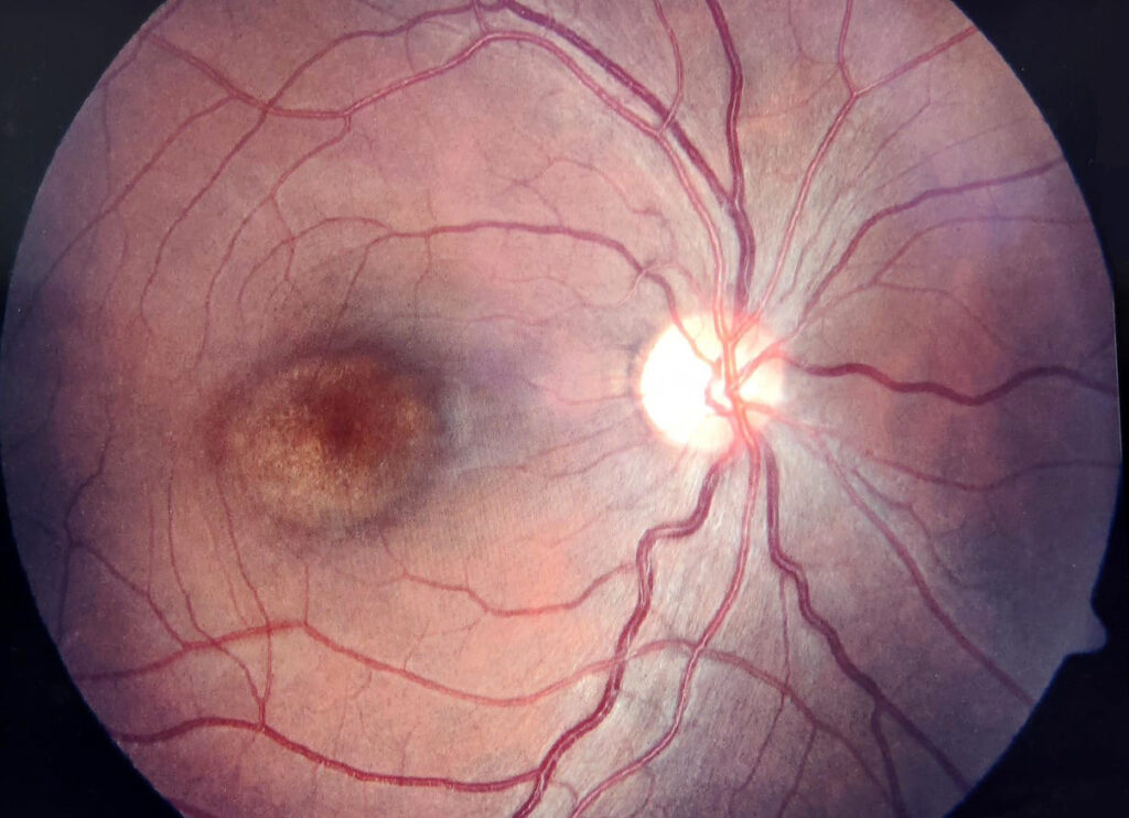 Bull's-Eye Maculopathy