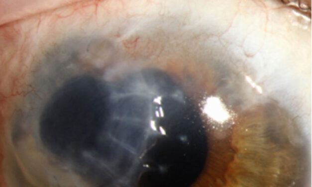 Terrien Marginal Degeneration: Not Every Peripheral Thinning Is Mooren’s