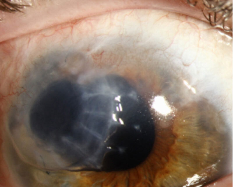Terrien Marginal Degeneration: Not Every Peripheral Thinning Is Mooren’s
