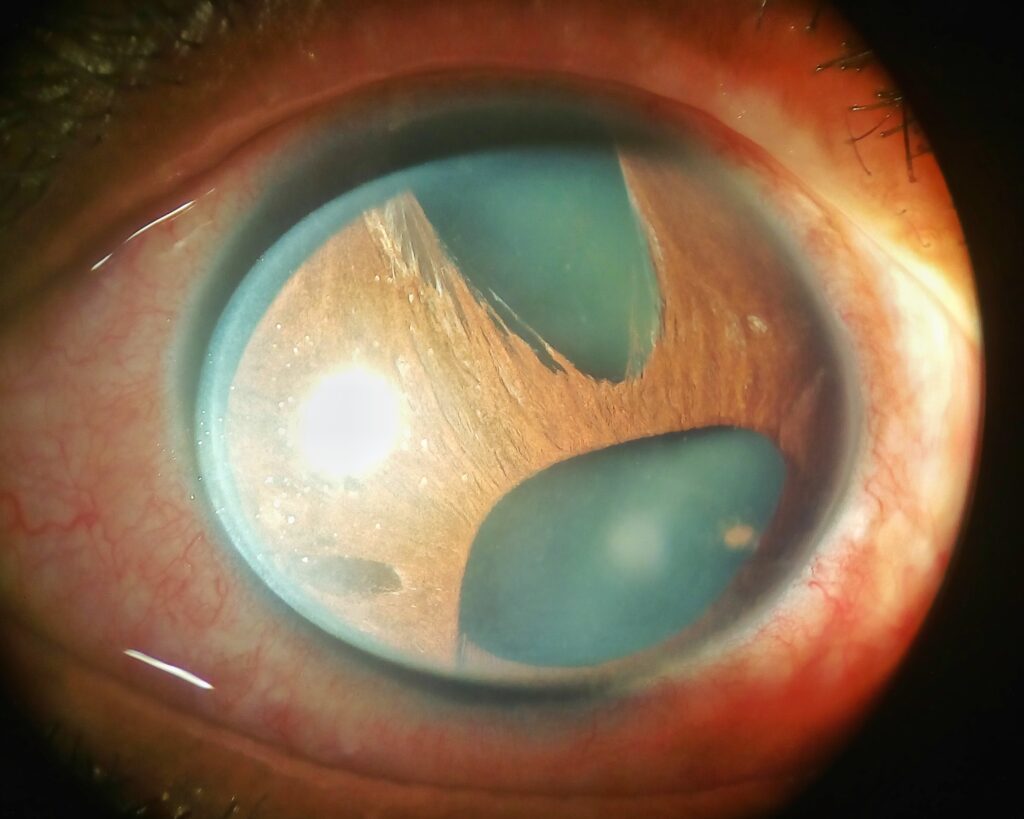 Iridocorneal Endothelial (ICE) Syndrome