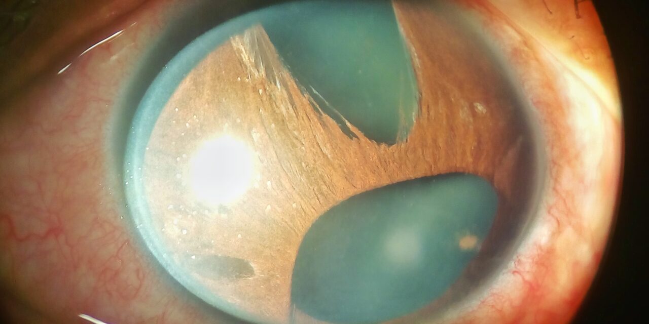 Iridocorneal Endothelial (ICE) Syndrome: A Full Review
