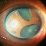 Iridocorneal Endothelial (ICE) Syndrome