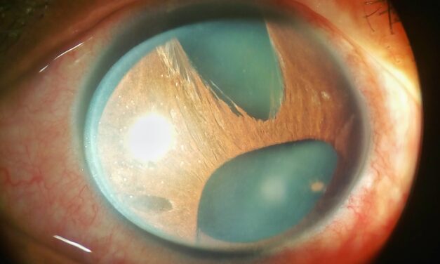 Iridocorneal Endothelial (ICE) Syndrome: A Full Review