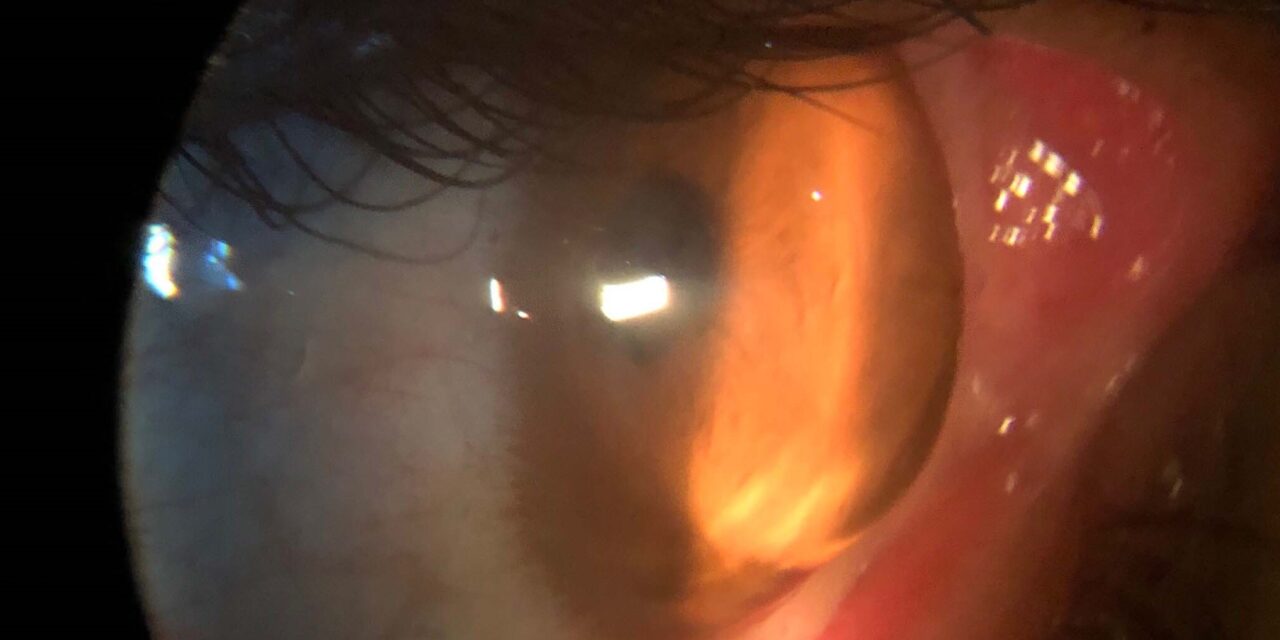 Keratoglobus: Diffuse Corneal Thinning Beyond Keratoconus