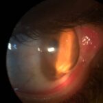 Keratoglobus