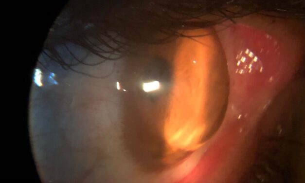 Keratoglobus: Diffuse Corneal Thinning Beyond Keratoconus