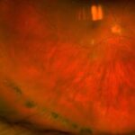 Lattice Degeneration - multimodal peripheral retinal imaging