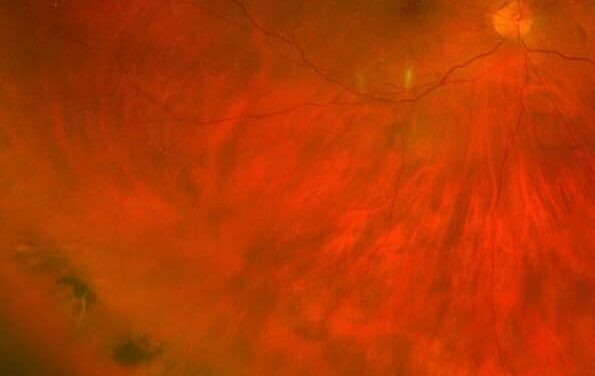 Lattice Degeneration: When a Common Finding Needs Treatment and When It Does Not