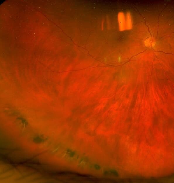 Lattice Degeneration: When a Common Finding Needs Treatment and When It Does Not