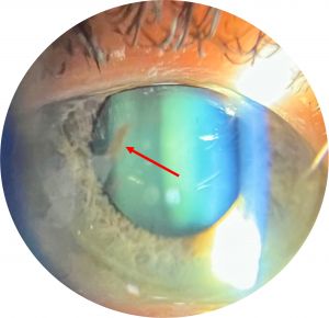Pigmentary Glaucoma