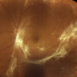 Vitreomacular traction