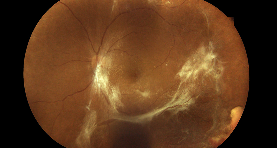 Vitreomacular Traction: Where a Patient Sits Between Adhesion and Hole
