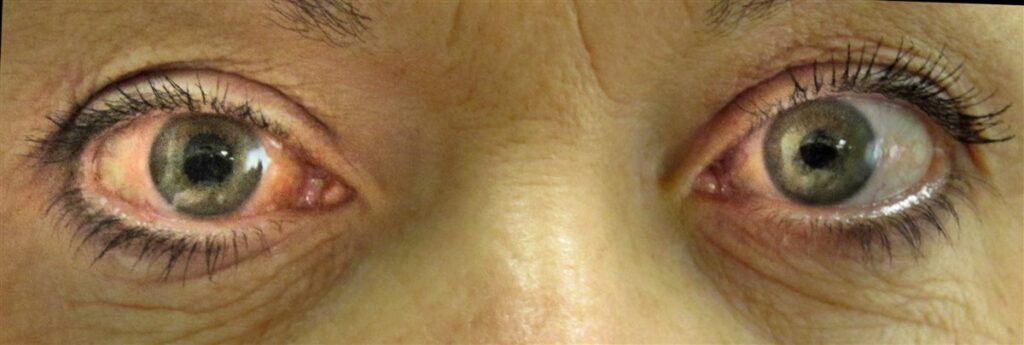 Acute angle-closure glaucoma: red right eye with a fixed mid-dilated pupil beside a normal fellow eye