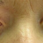 Acute angle-closure glaucoma: red right eye with a fixed mid-dilated pupil beside a normal fellow eye