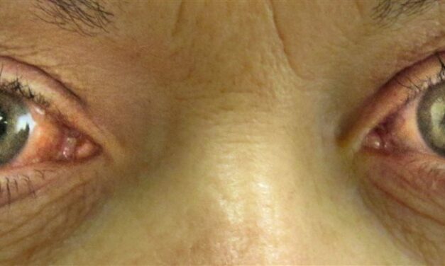 Acute Angle-Closure Glaucoma: The Red Eye You Cannot Afford to Send Home