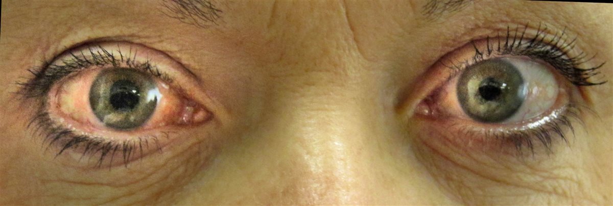 Acute Angle-Closure Glaucoma: The Red Eye You Cannot Afford to Send Home
