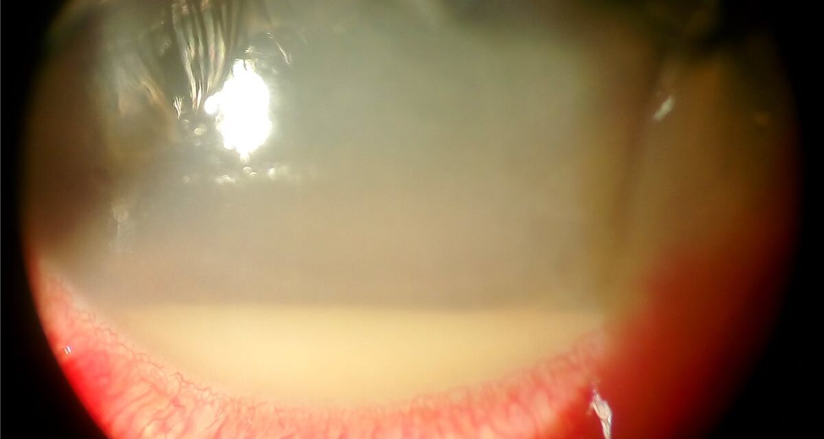 Acute Postoperative Endophthalmitis: Why Presenting Vision Decides the First Move