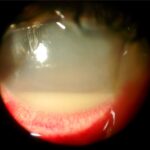Acute postoperative endophthalmitis: a slit-lamp photograph showing a layered hypopyon in the anterior chamber with marked conjunctival injection and corneal haze, findings prompting emergency intravitreal sampling and antibiotic injection