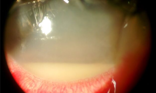 Acute Postoperative Endophthalmitis: Why Presenting Vision Decides the First Move