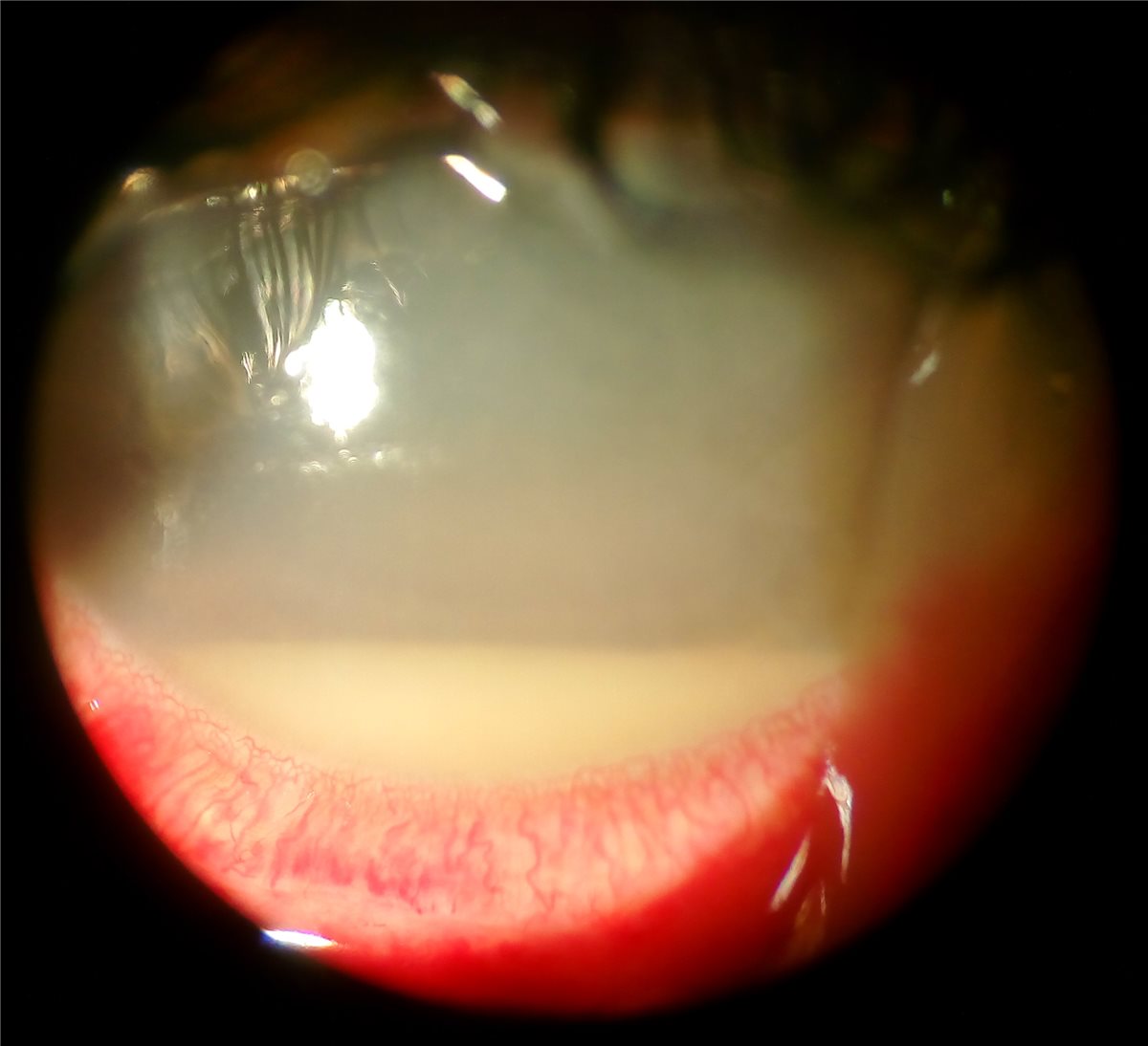 Acute postoperative endophthalmitis: a slit-lamp photograph showing a layered hypopyon in the anterior chamber with marked conjunctival injection and corneal haze, findings prompting emergency intravitreal sampling and antibiotic injection