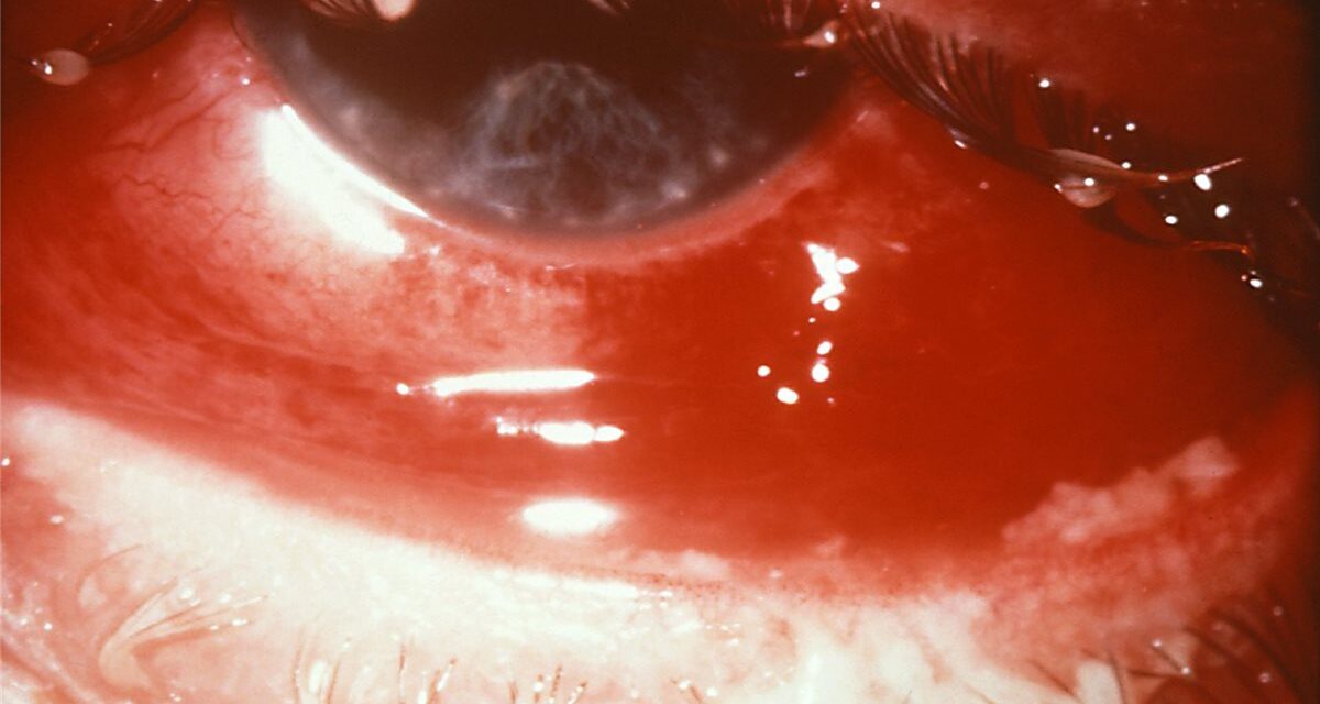 Adult Gonococcal Conjunctivitis: The Red Eye That Can Perforate in Days