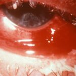 Adult gonococcal conjunctivitis: intense conjunctival injection with subconjunctival haemorrhage and corneal haze in hyperacute gonococcal conjunctivitis