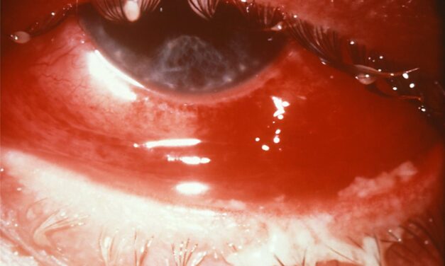 Adult Gonococcal Conjunctivitis: The Red Eye That Can Perforate in Days