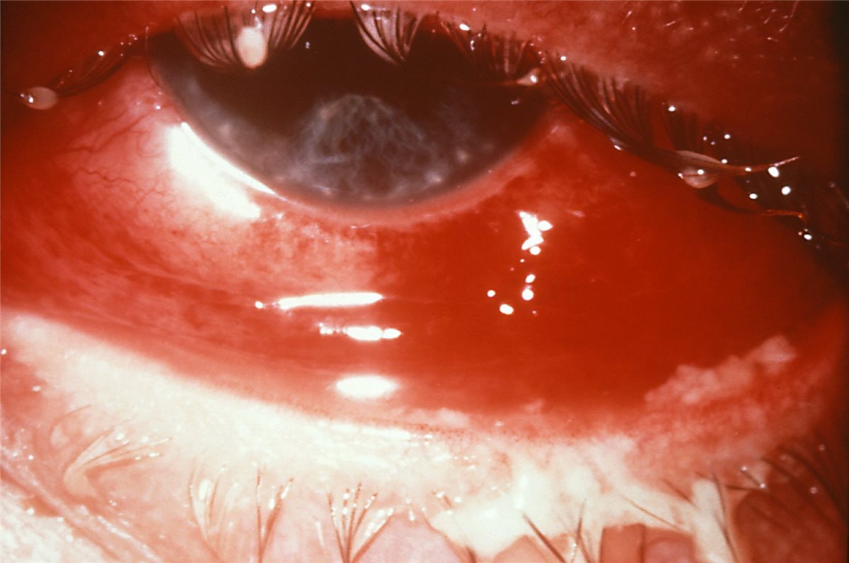 Adult gonococcal conjunctivitis: intense conjunctival injection with subconjunctival haemorrhage and corneal haze in hyperacute gonococcal conjunctivitis
