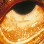 Adult inclusion conjunctivitis: follicular reaction of the lower tarsal conjunctiva in chlamydial infection