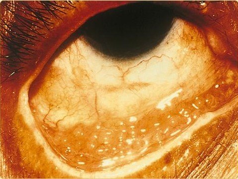 Adult Inclusion Conjunctivitis: A Sexually Transmitted Cause of Red Eye