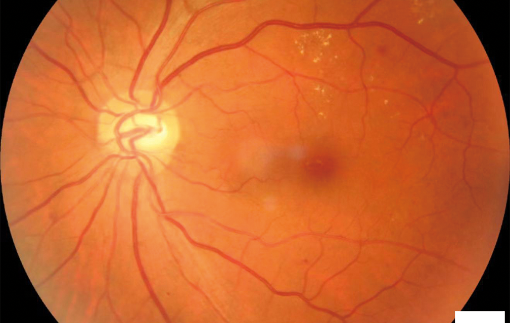 AI Diabetic Retinopathy Screening: What the Algorithm Actually Does