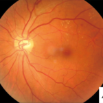 Diabetic retinopathy screening image: a colour fundus photograph showing hard exudates, microaneurysms and dot haemorrhages - the lesions an automated screening algorithm is trained to detect