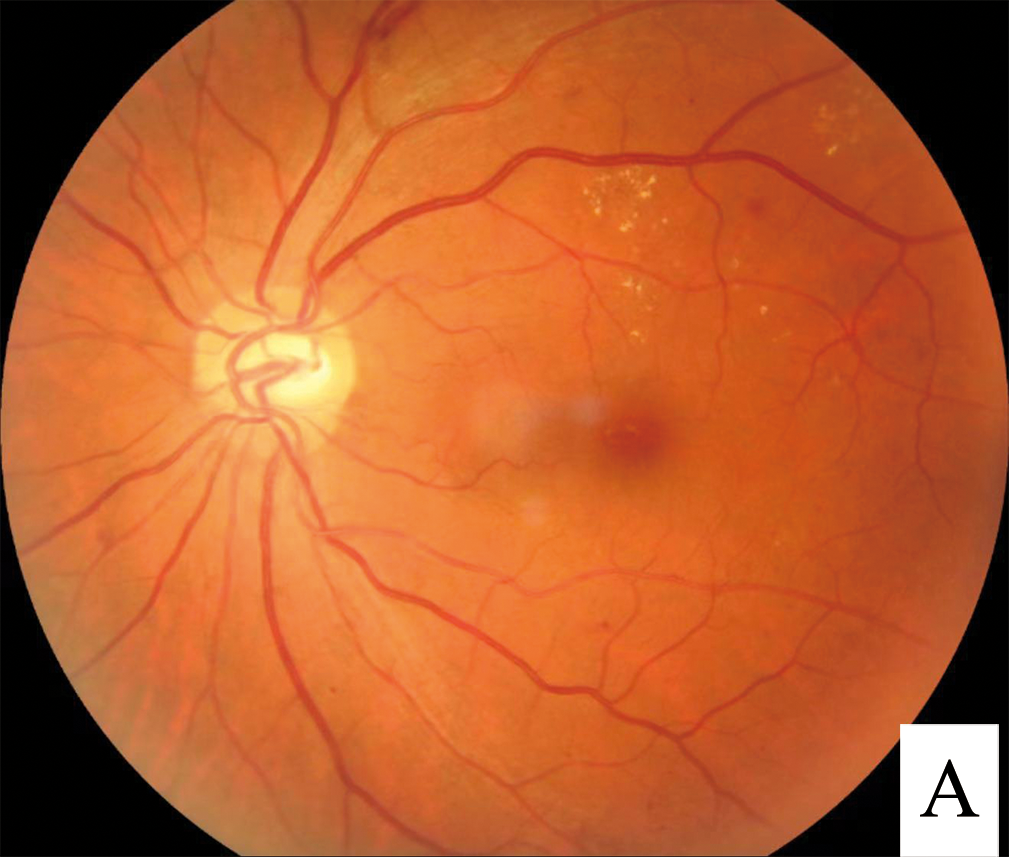 Diabetic retinopathy screening image: a colour fundus photograph showing hard exudates, microaneurysms and dot haemorrhages - the lesions an automated screening algorithm is trained to detect