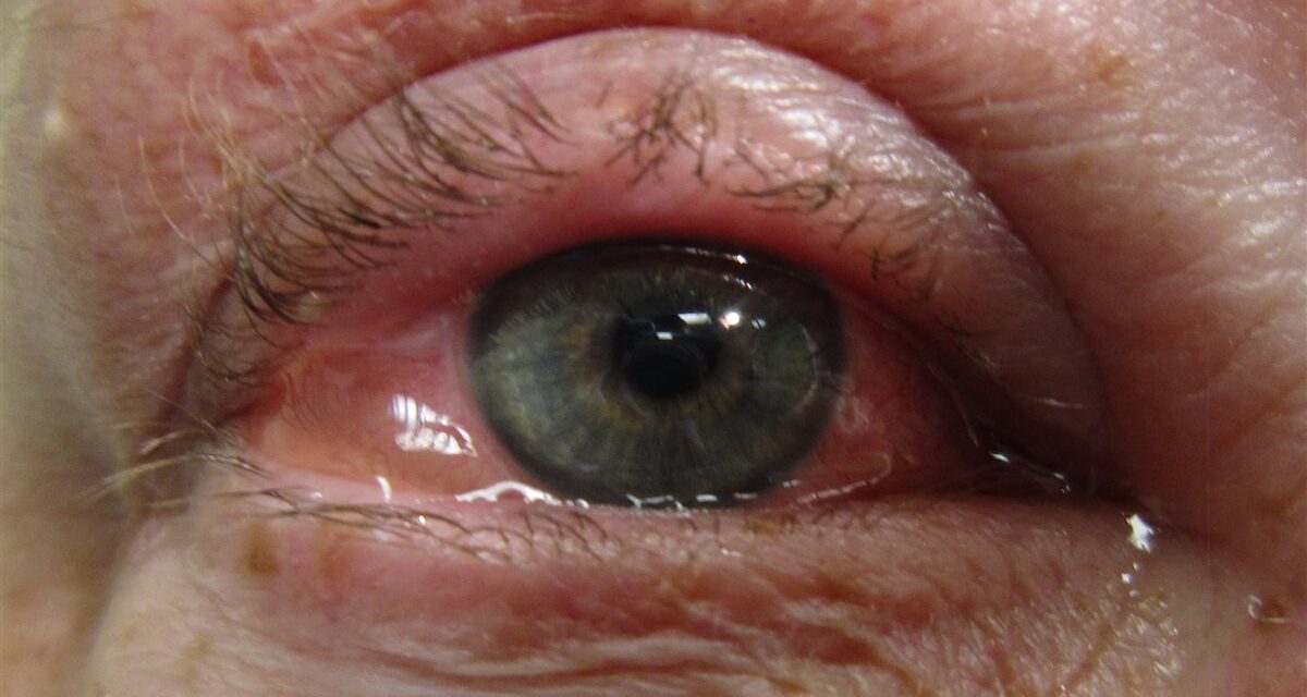 Allergic Conjunctivitis: Itching Is the Diagnosis
