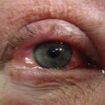 Allergic conjunctivitis: diffuse conjunctival injection with a watery discharge and mild eyelid margin erythema, without purulent discharge