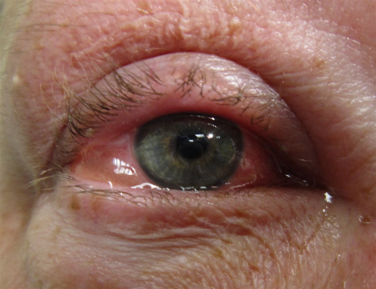 Allergic conjunctivitis: diffuse conjunctival injection with a watery discharge and mild eyelid margin erythema, without purulent discharge