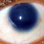 Aniridia: a uniformly large, dark pupillary aperture with complete absence of visible iris tissue, sclera bordering directly onto the corneal limbus